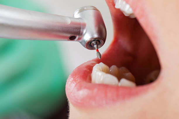 Best Emergency Dental Care for Broken or Chipped Teeth in North Bend, NE